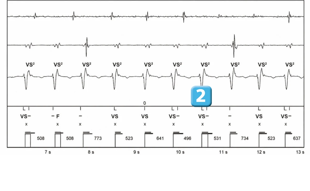 Abbott ICD electrogram, segment 2 of 3 — New device, dual R-wave counting and SecureSense™ algorithm