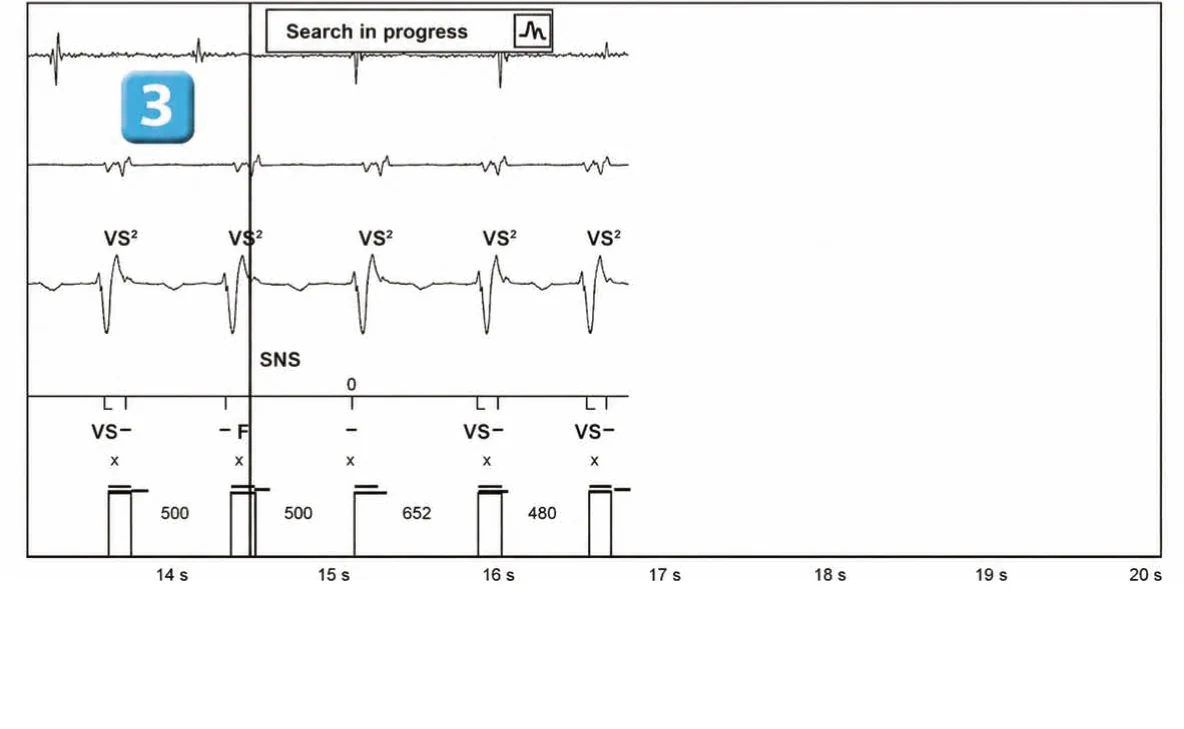 Abbott ICD electrogram, segment 3 of 3 — New device, dual R-wave counting and SecureSense™ algorithm