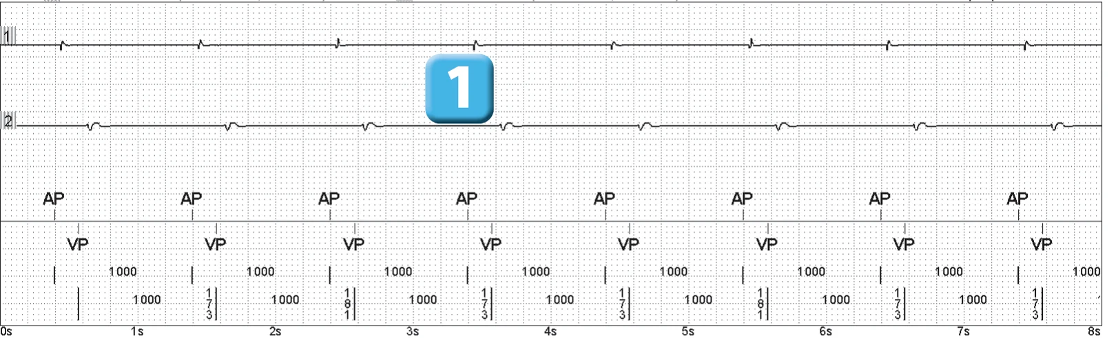 Abbott ICD electrogram, segment 1 of 14 — Episode of ventricular fibrillation and high defibrillation threshold
