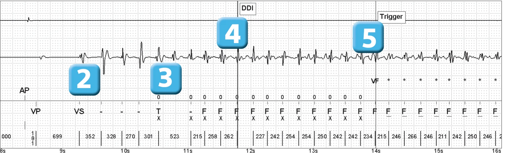 Abbott ICD electrogram, segment 2 of 14 — Episode of ventricular fibrillation and high defibrillation threshold
