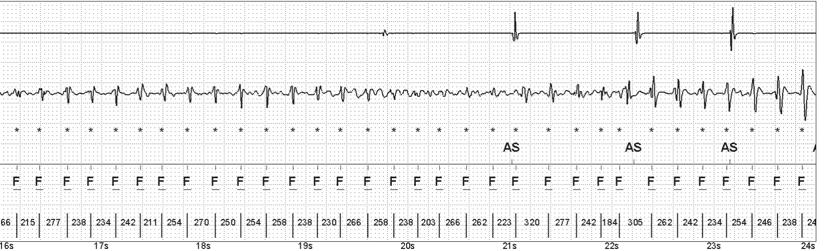 Abbott ICD electrogram, segment 3 of 14 — Episode of ventricular fibrillation and high defibrillation threshold