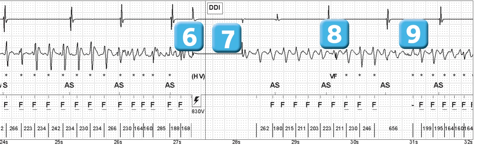 Abbott ICD electrogram, segment 4 of 14 — Episode of ventricular fibrillation and high defibrillation threshold