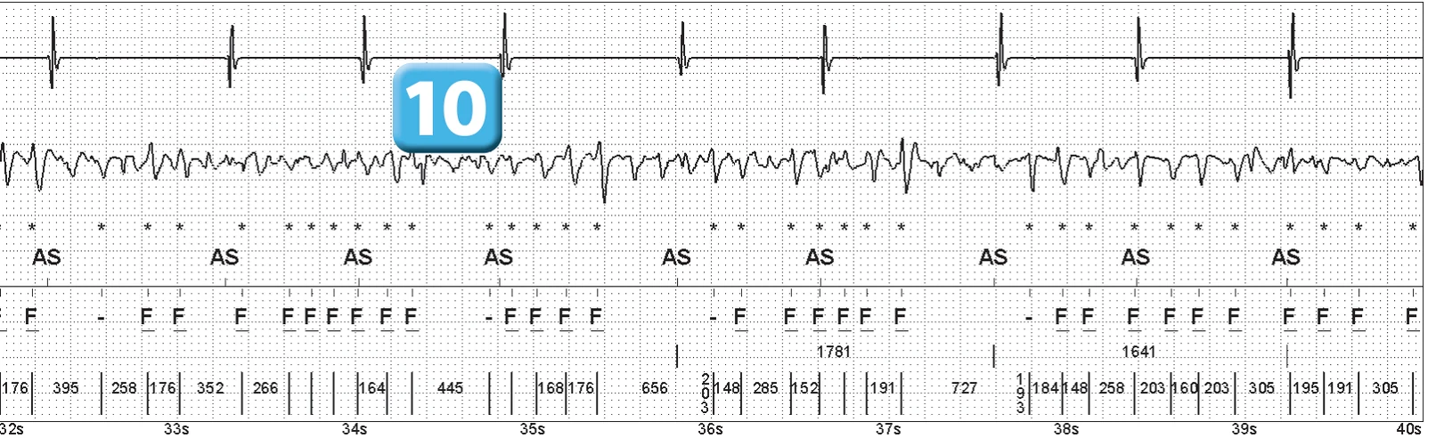 Abbott ICD electrogram, segment 5 of 14 — Episode of ventricular fibrillation and high defibrillation threshold