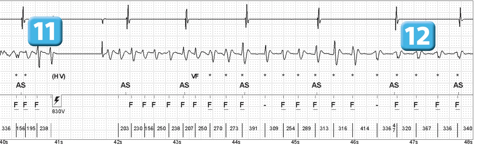 Abbott ICD electrogram, segment 6 of 14 — Episode of ventricular fibrillation and high defibrillation threshold