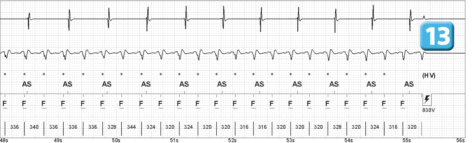 Abbott ICD electrogram, segment 7 of 14 — Episode of ventricular fibrillation and high defibrillation threshold