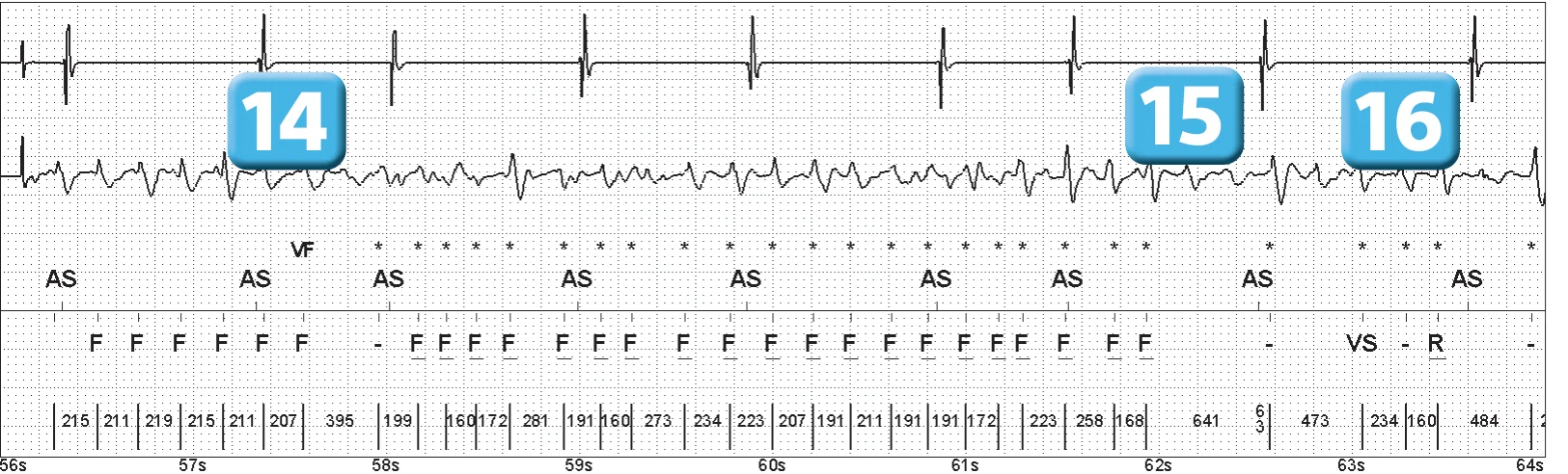 Abbott ICD electrogram, segment 8 of 14 — Episode of ventricular fibrillation and high defibrillation threshold
