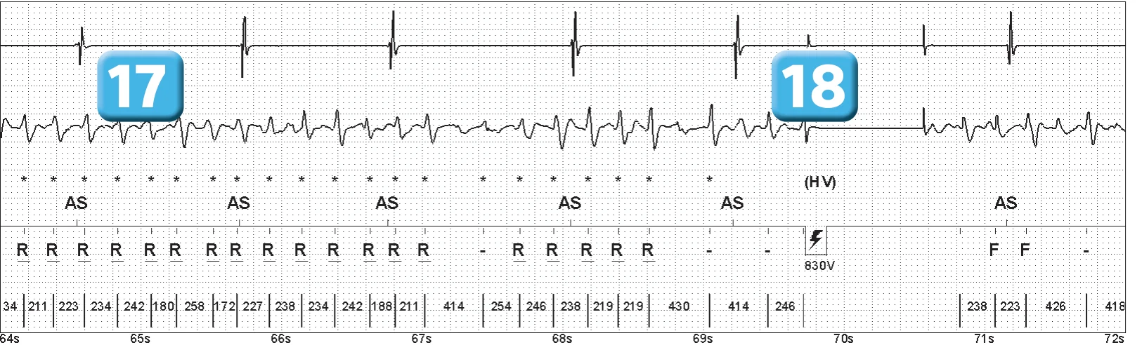 Abbott ICD electrogram, segment 9 of 14 — Episode of ventricular fibrillation and high defibrillation threshold