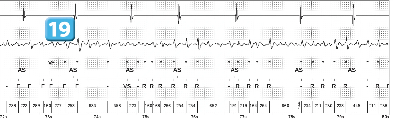 Abbott ICD electrogram, segment 10 of 14 — Episode of ventricular fibrillation and high defibrillation threshold