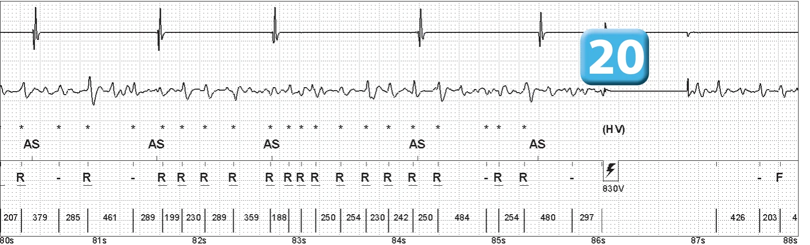 Abbott ICD electrogram, segment 11 of 14 — Episode of ventricular fibrillation and high defibrillation threshold