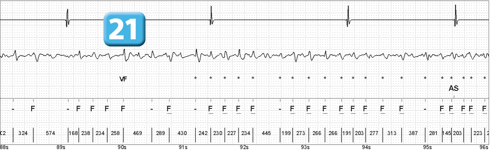Abbott ICD electrogram, segment 12 of 14 — Episode of ventricular fibrillation and high defibrillation threshold