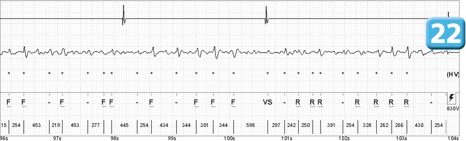 Abbott ICD electrogram, segment 13 of 14 — Episode of ventricular fibrillation and high defibrillation threshold