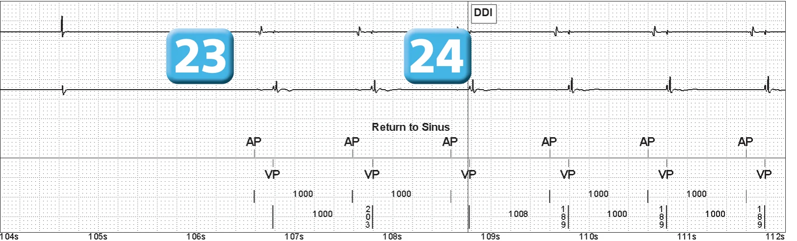 Abbott ICD electrogram, segment 14 of 14 — Episode of ventricular fibrillation and high defibrillation threshold