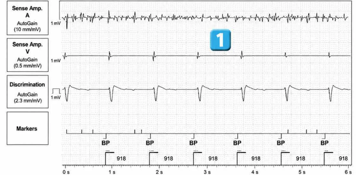 Abbott ICD electrogram, segment 1 of 6 — Lead dysfunction and DynamicTx™ algorithm