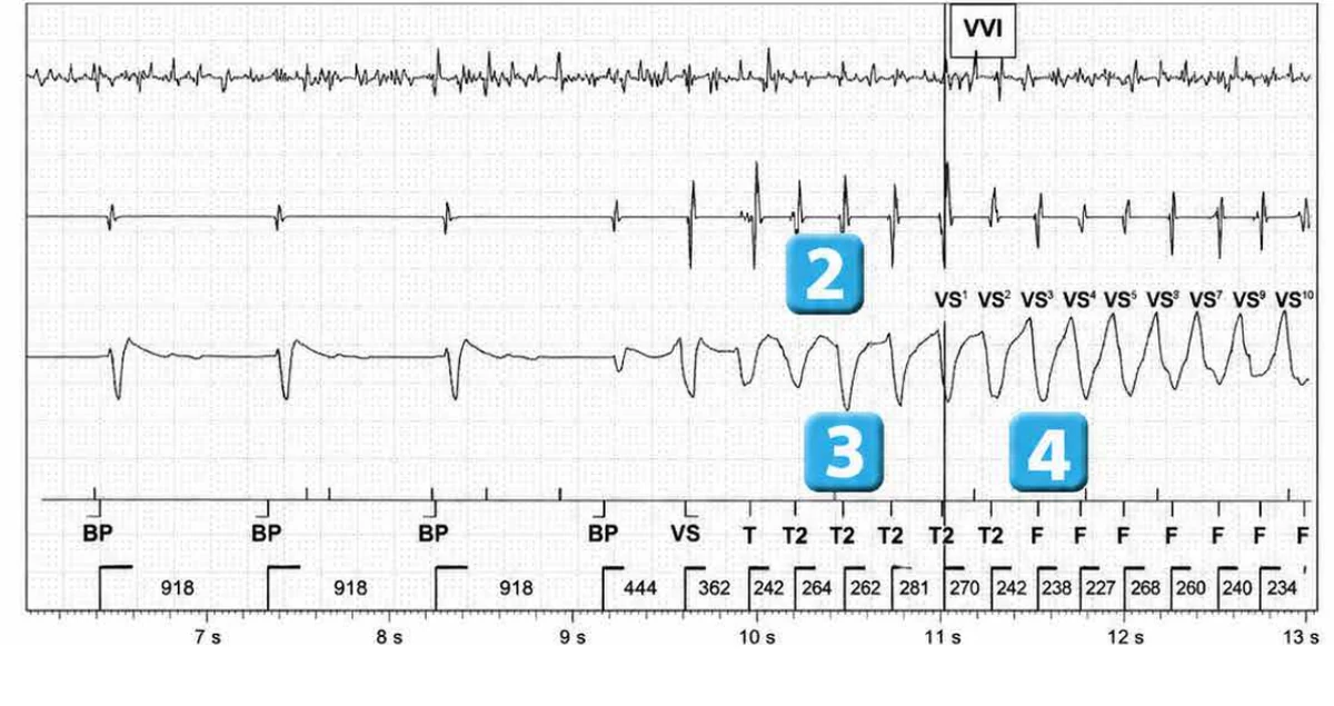 Abbott ICD electrogram, segment 2 of 6 — Lead dysfunction and DynamicTx™ algorithm