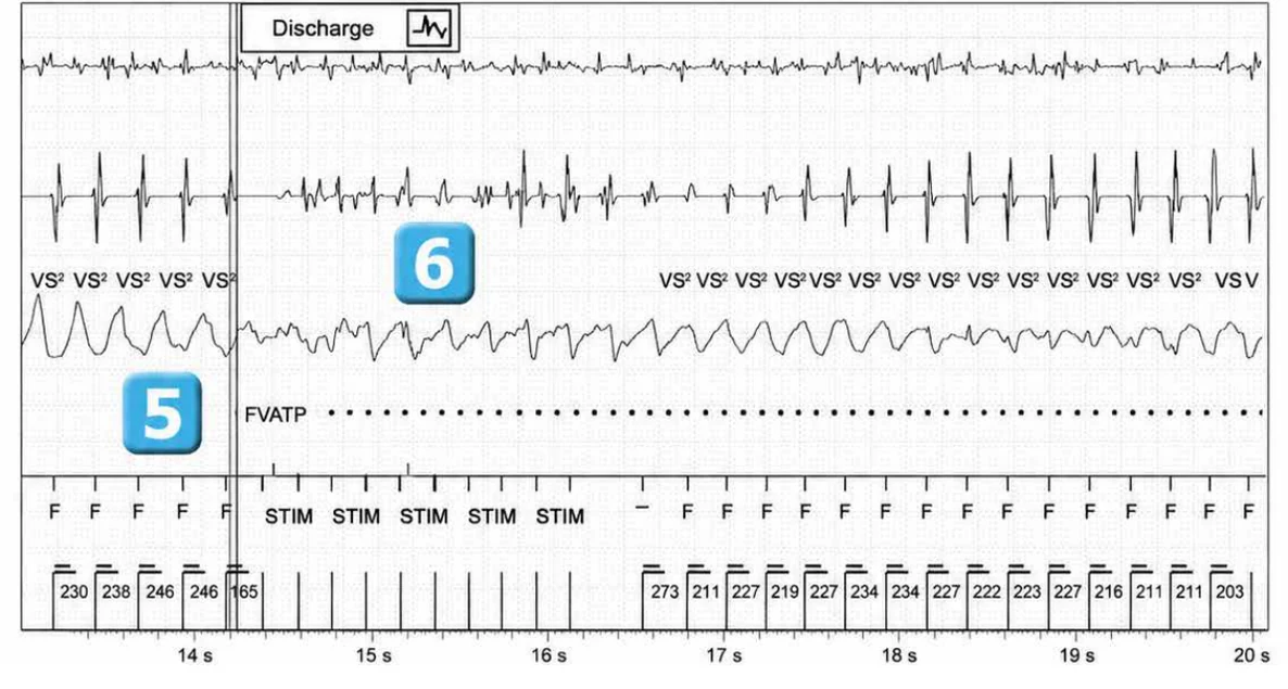 Abbott ICD electrogram, segment 3 of 6 — Lead dysfunction and DynamicTx™ algorithm