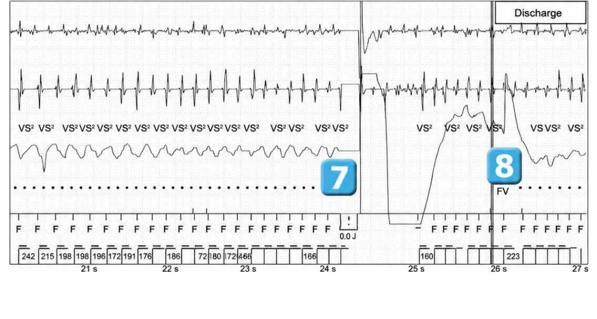 Abbott ICD electrogram, segment 4 of 6 — Lead dysfunction and DynamicTx™ algorithm