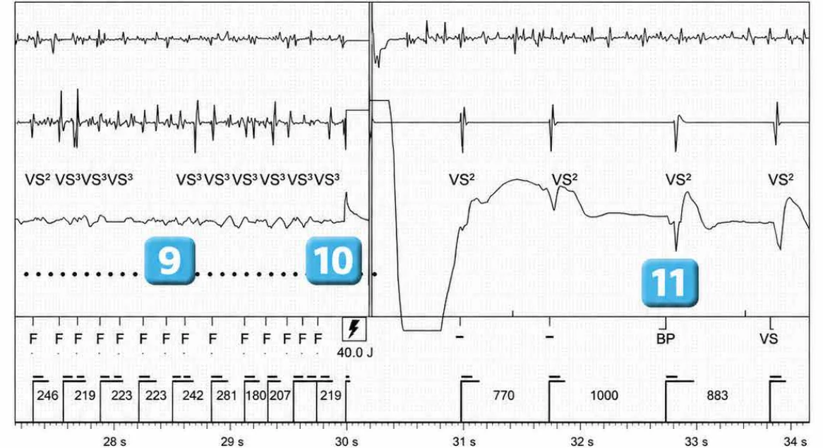 Abbott ICD electrogram, segment 5 of 6 — Lead dysfunction and DynamicTx™ algorithm