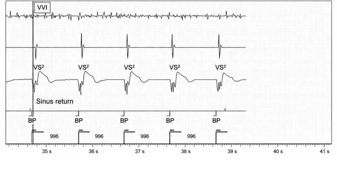 Abbott ICD electrogram, segment 6 of 6 — Lead dysfunction and DynamicTx™ algorithm