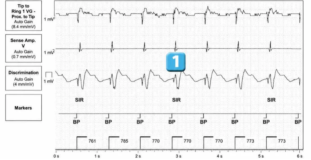 Abbott ICD electrogram, segment 1 of 7 — Activation of the VFTA algorithm to promote the delivery of an electric shock during an episode of ventricular arrhythmia