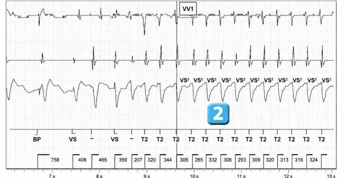 Abbott ICD electrogram, segment 2 of 7 — Activation of the VFTA algorithm to promote the delivery of an electric shock during an episode of ventricular arrhythmia