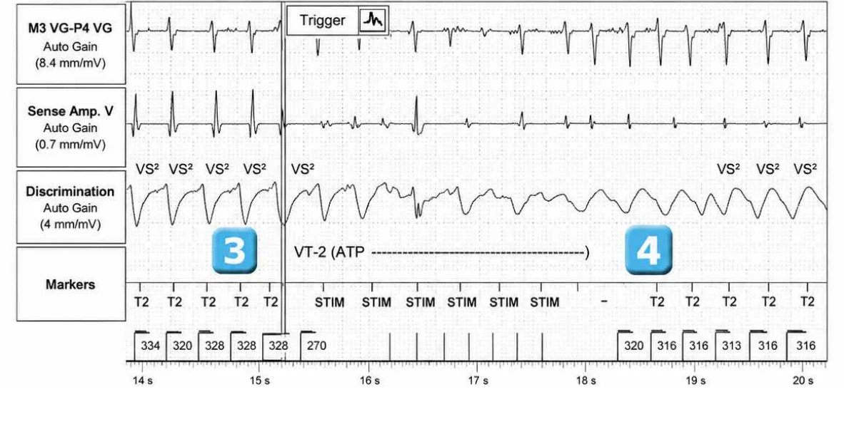 Abbott ICD electrogram, segment 3 of 7 — Activation of the VFTA algorithm to promote the delivery of an electric shock during an episode of ventricular arrhythmia