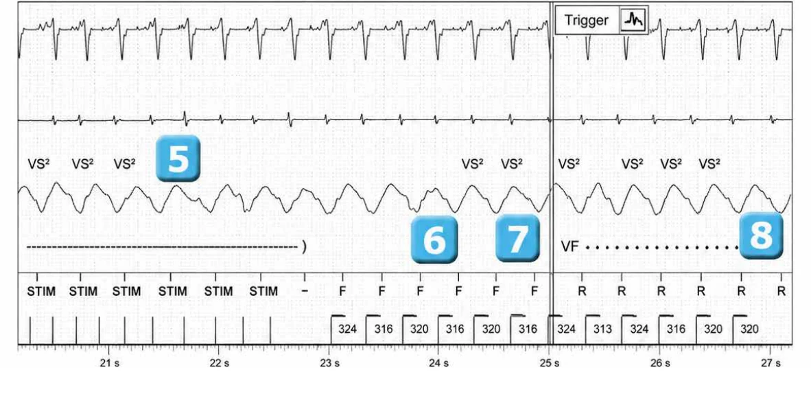 Abbott ICD electrogram, segment 4 of 7 — Activation of the VFTA algorithm to promote the delivery of an electric shock during an episode of ventricular arrhythmia