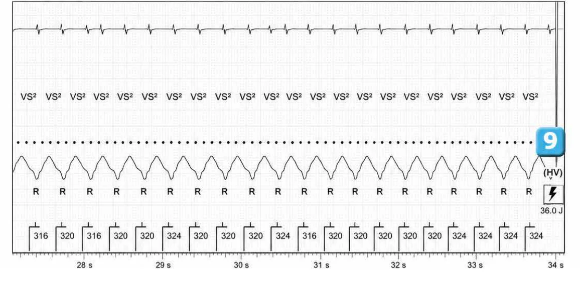 Abbott ICD electrogram, segment 5 of 7 — Activation of the VFTA algorithm to promote the delivery of an electric shock during an episode of ventricular arrhythmia
