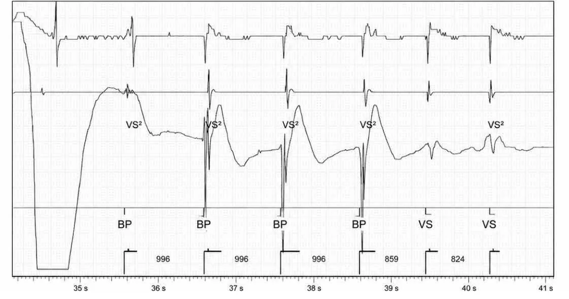 Abbott ICD electrogram, segment 6 of 7 — Activation of the VFTA algorithm to promote the delivery of an electric shock during an episode of ventricular arrhythmia