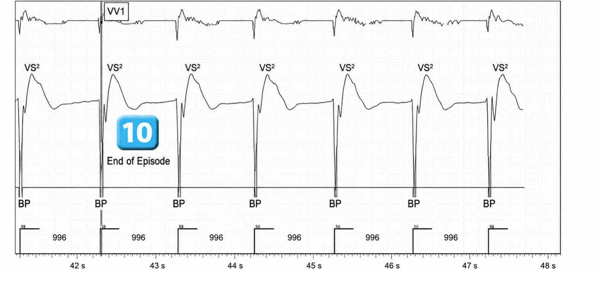 Abbott ICD electrogram, segment 7 of 7 — Activation of the VFTA algorithm to promote the delivery of an electric shock during an episode of ventricular arrhythmia
