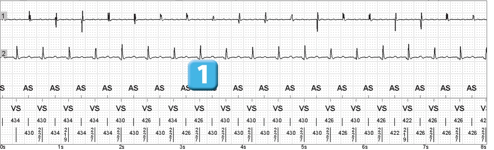 Abbott ICD electrogram, segment 1 of 5 — Electrical shock and induction of an AF episode