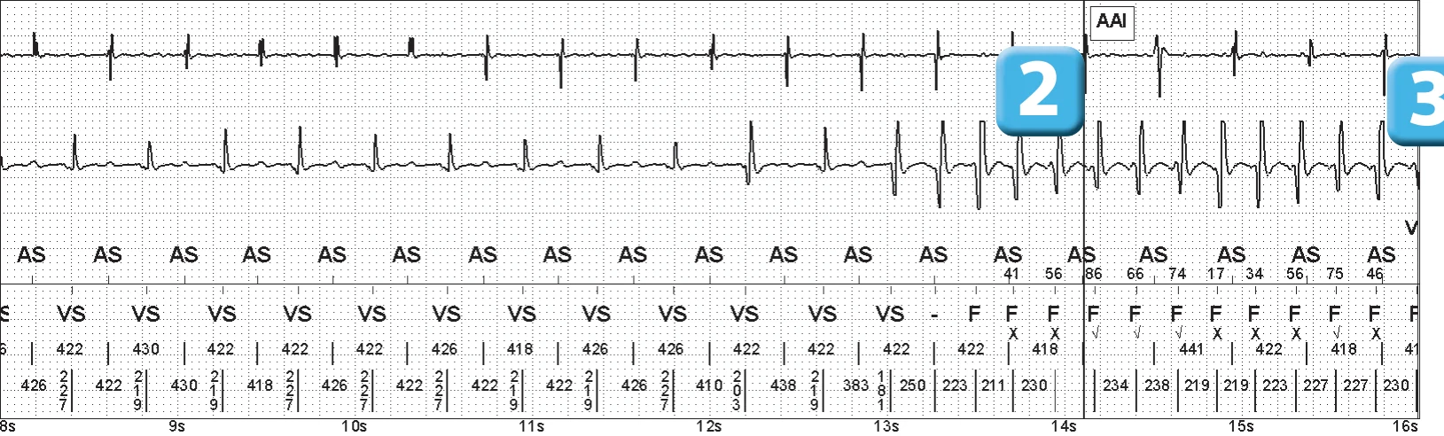 Abbott ICD electrogram, segment 2 of 5 — Electrical shock and induction of an AF episode