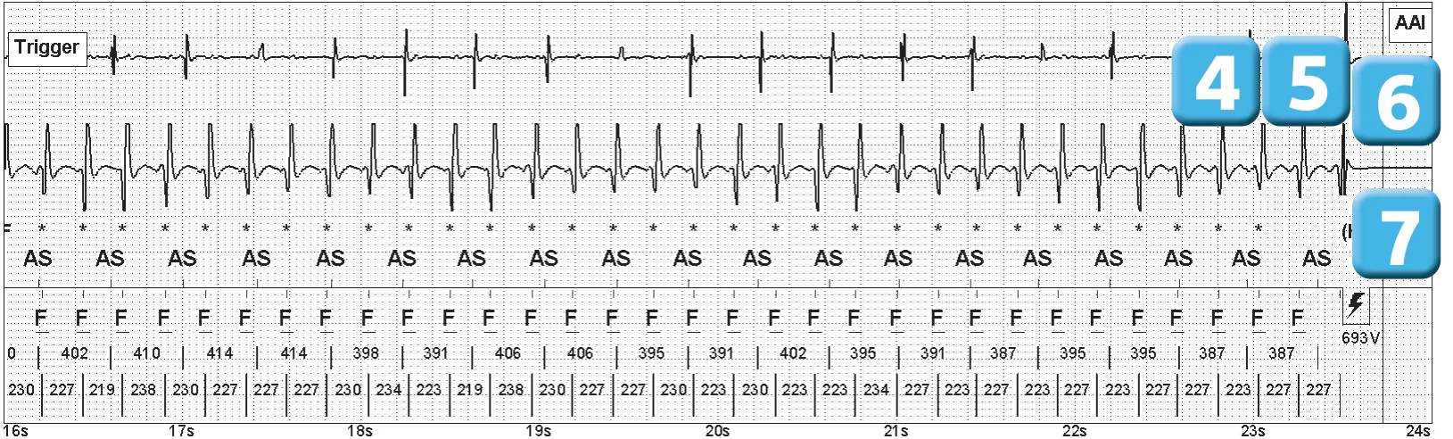 Abbott ICD electrogram, segment 3 of 5 — Electrical shock and induction of an AF episode