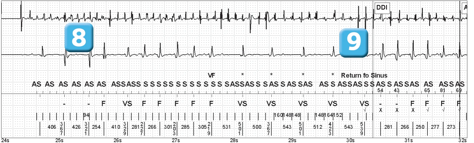 Abbott ICD electrogram, segment 4 of 5 — Electrical shock and induction of an AF episode