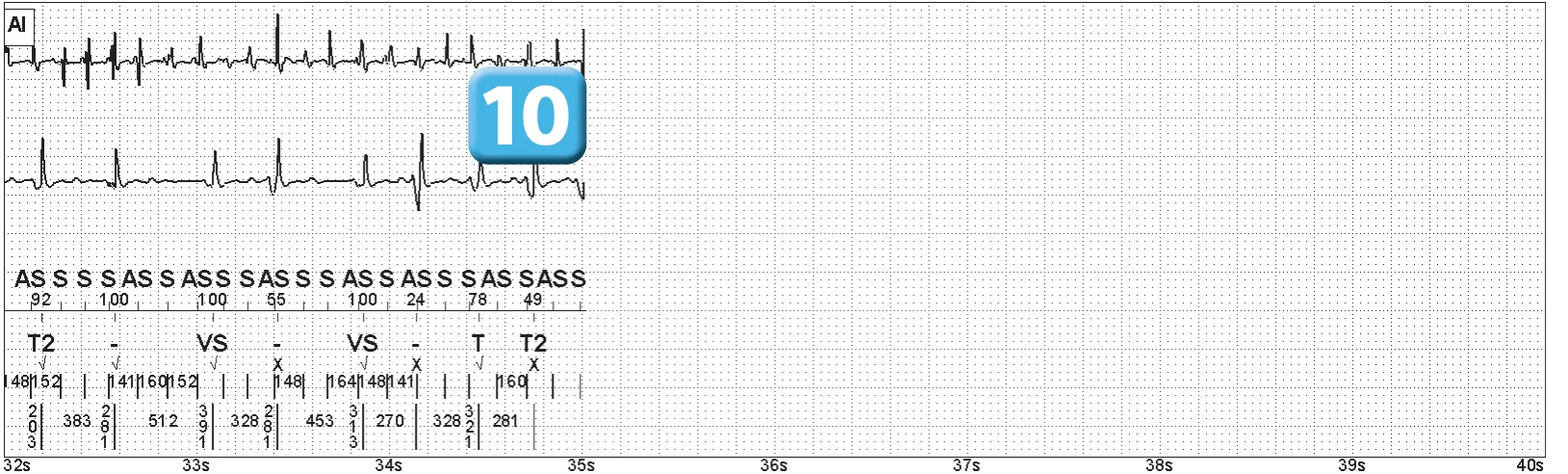 Abbott ICD electrogram, segment 5 of 5 — Electrical shock and induction of an AF episode