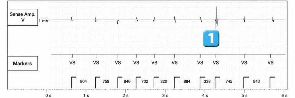 Abbott ICD electrogram, segment 1 of 4 — Anti-tachycardia pacing during or before charging in the VF zone