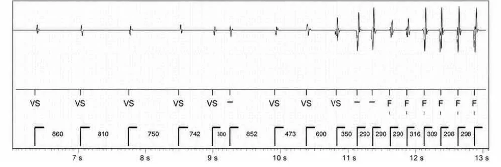 Abbott ICD electrogram, segment 2 of 4 — Anti-tachycardia pacing during or before charging in the VF zone