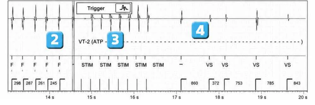 Abbott ICD electrogram, segment 3 of 4 — Anti-tachycardia pacing during or before charging in the VF zone