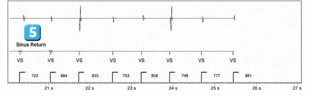 Abbott ICD electrogram, segment 4 of 4 — Anti-tachycardia pacing during or before charging in the VF zone