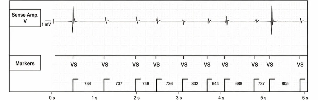 Abbott ICD electrogram, segment 1 of 5 — Anti-tachycardia pacing during or before charging in the VF zone