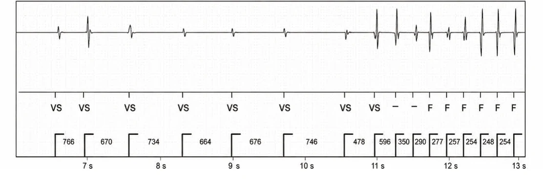 Abbott ICD electrogram, segment 2 of 5 — Anti-tachycardia pacing during or before charging in the VF zone
