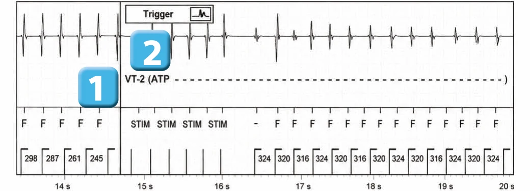 Abbott ICD electrogram, segment 3 of 5 — Anti-tachycardia pacing during or before charging in the VF zone