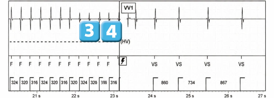 Abbott ICD electrogram, segment 4 of 5 — Anti-tachycardia pacing during or before charging in the VF zone