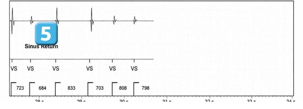 Abbott ICD electrogram, segment 5 of 5 — Anti-tachycardia pacing during or before charging in the VF zone