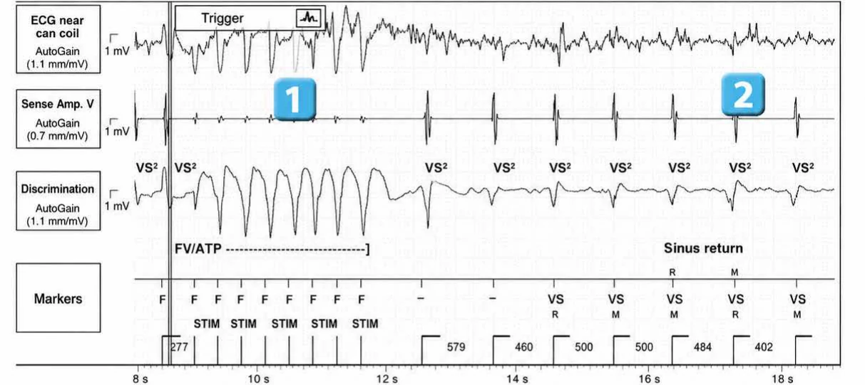 Abbott ICD electrogram, segment 1 of 3 — Anti-tachycardia pacing during or before charging in the VF zone