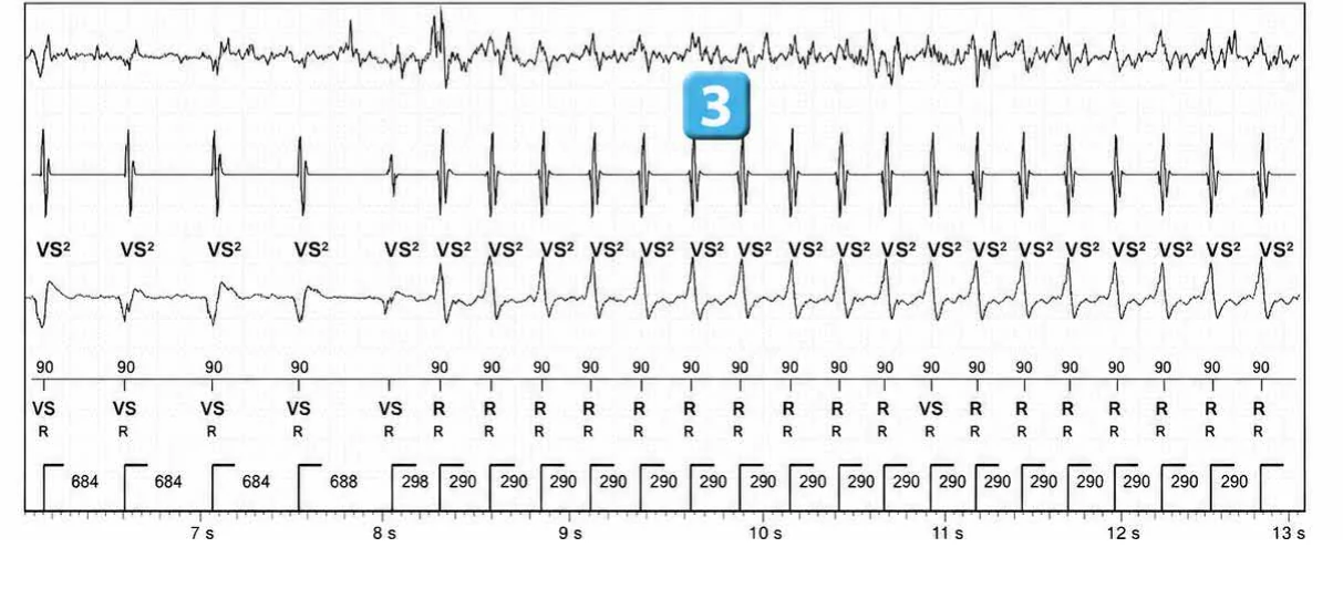 Abbott ICD electrogram, segment 2 of 3 — Anti-tachycardia pacing during or before charging in the VF zone