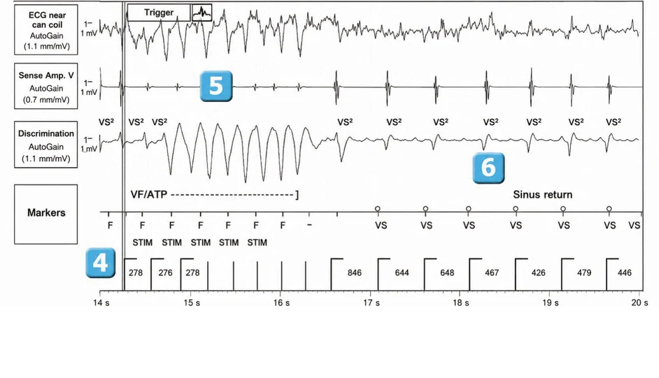 Abbott ICD electrogram, segment 3 of 3 — Anti-tachycardia pacing during or before charging in the VF zone