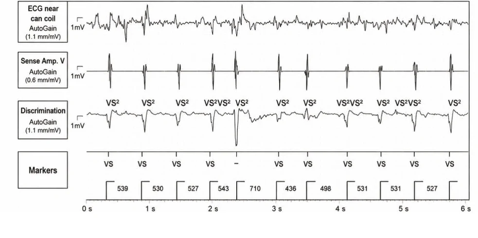 Abbott ICD electrogram, segment 1 of 5 — Anti-tachycardia pacing during or before charging in the VF zone