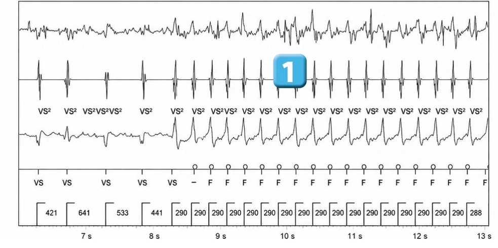 Abbott ICD electrogram, segment 2 of 5 — Anti-tachycardia pacing during or before charging in the VF zone