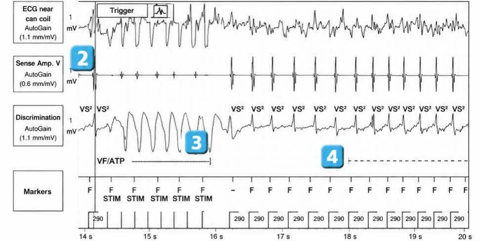 Abbott ICD electrogram, segment 3 of 5 — Anti-tachycardia pacing during or before charging in the VF zone