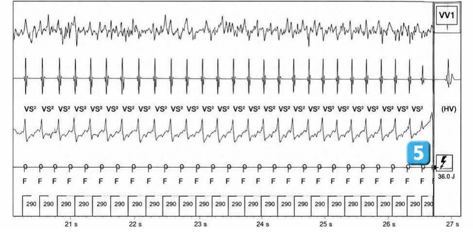 Abbott ICD electrogram, segment 4 of 5 — Anti-tachycardia pacing during or before charging in the VF zone